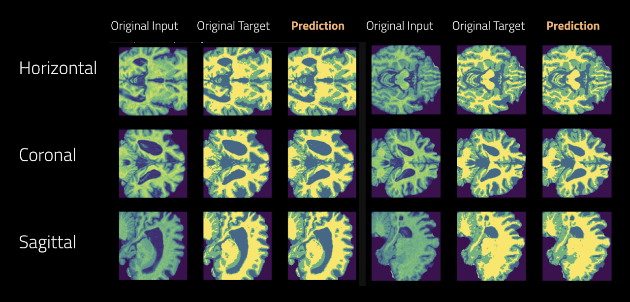 Brain MRI segmentation predictions in horizontal, coronal, and sagittal views