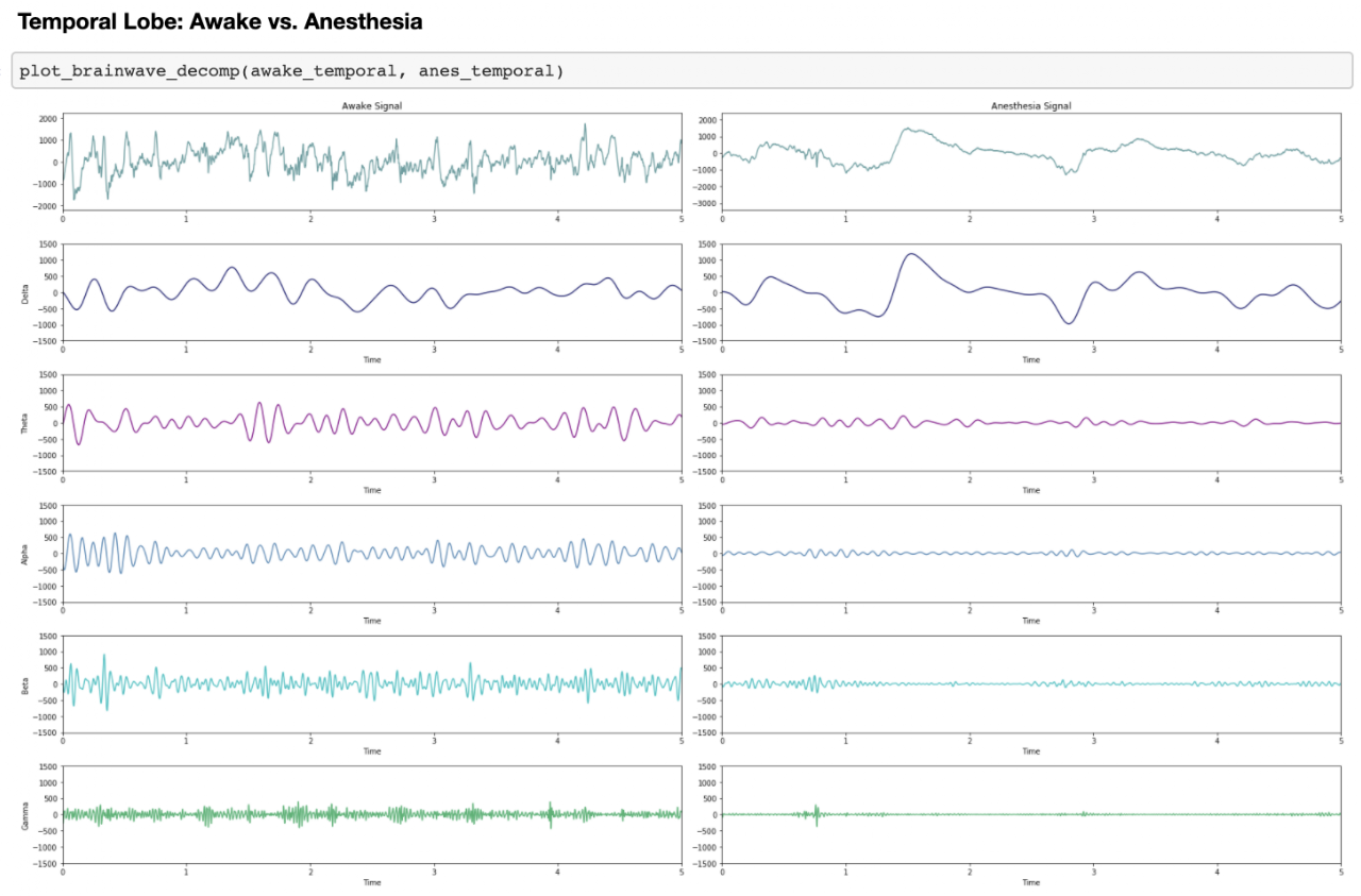 Brainwave decomposition of temporal lobe signal, awake vs anesthesia